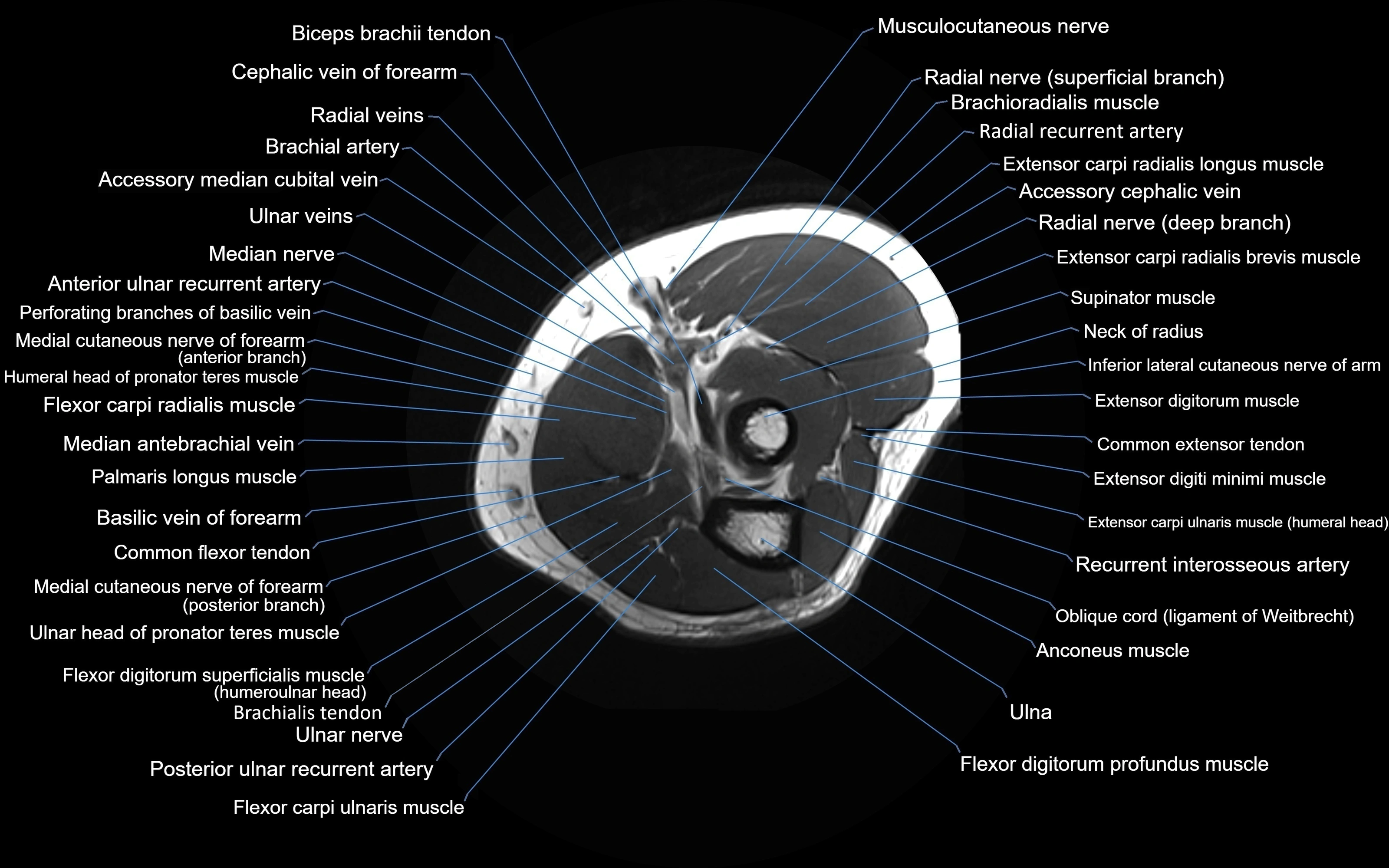 MRI elbow axial cross sectional anatomy 3T  radiology  image-img-00001-00022.webp
